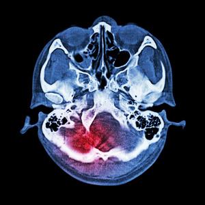 脑损伤卒中脑和颅底CT扫描