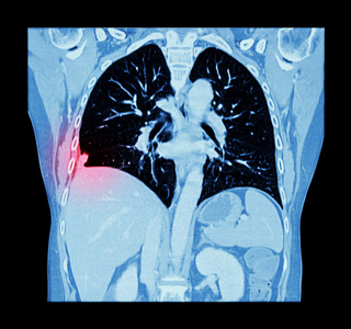 肺癌胸腹部ct扫描右肺可