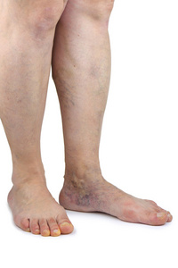 静脉曲张上肢的骨头人类的双腿静脉曲张曲张静脉正常的滑膜关节的解剖