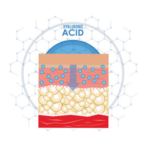 透明质酸填料注入信息图