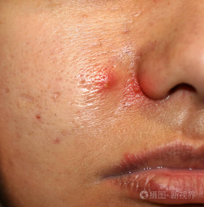 红色的丘疹化脓性.痤疮.瘢痕疙瘩.扩大的毛孔