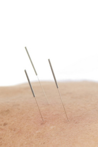 针灸针在背照片