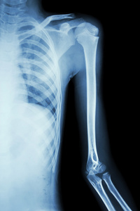 薄膜 x 射线左的肩