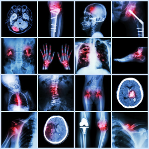人类多种疾病的一组x射线多部分