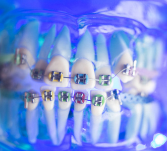 牙科牙齿金属支架