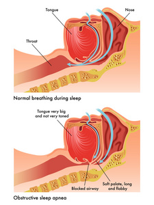 阻塞性睡眠呼吸暂停