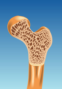 股骨矩阵多彩的骨质疏松症计划照片