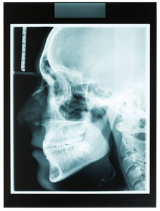男人下巴与牙齿的 x 光照片