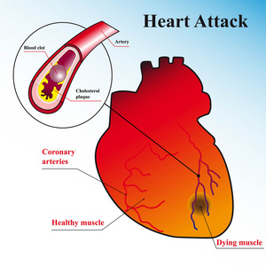 心脏病发作的对过程的示意图说明
