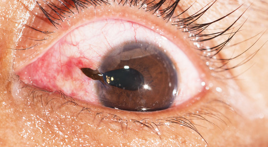 眼部检查,眼球破裂照片