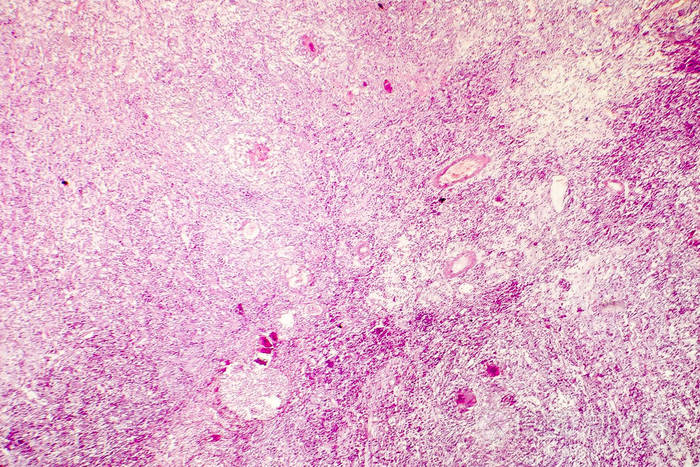 人类的大脑轻的光学显微镜的液化性坏死