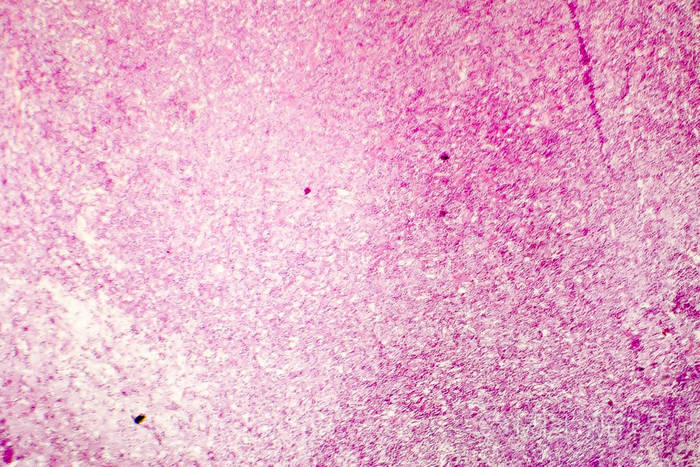 人类的大脑,轻的光学显微镜的液化性坏死