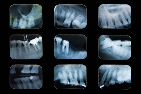 牙科 x 光胶片
