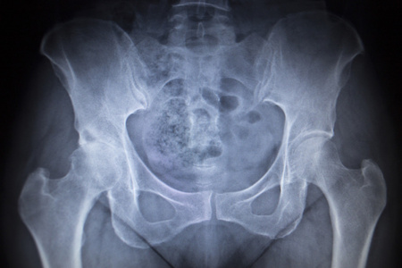 ct淋巴,骨骼,神经和循环系统的女博x 射线髋关节人类骨骼的骨科扫描的