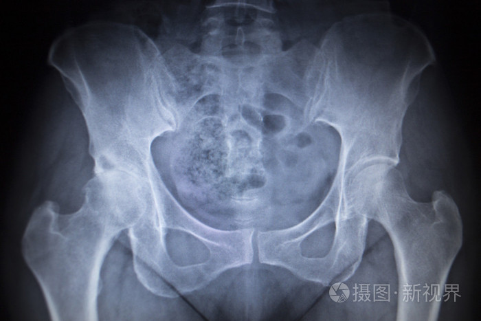 x射线髋关节人类骨骼的骨科扫描的图像