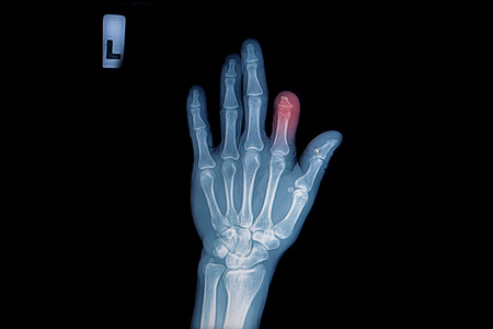 X 射线的创伤手和手指