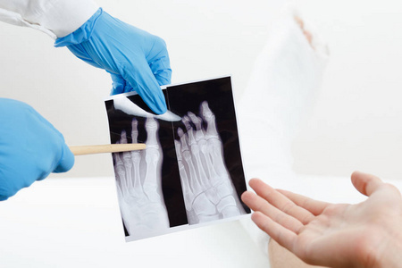 医生显示病人的 x 射线图像的手指折断的腿打上石膏