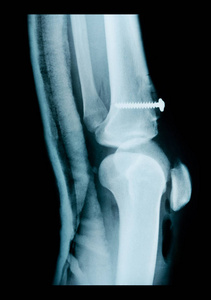 X 射线人体膝关节