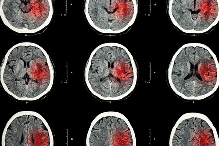 脑红区CT扫描出血性脑卒中影像学