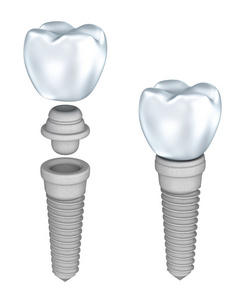 牙科植入物上白色孤立