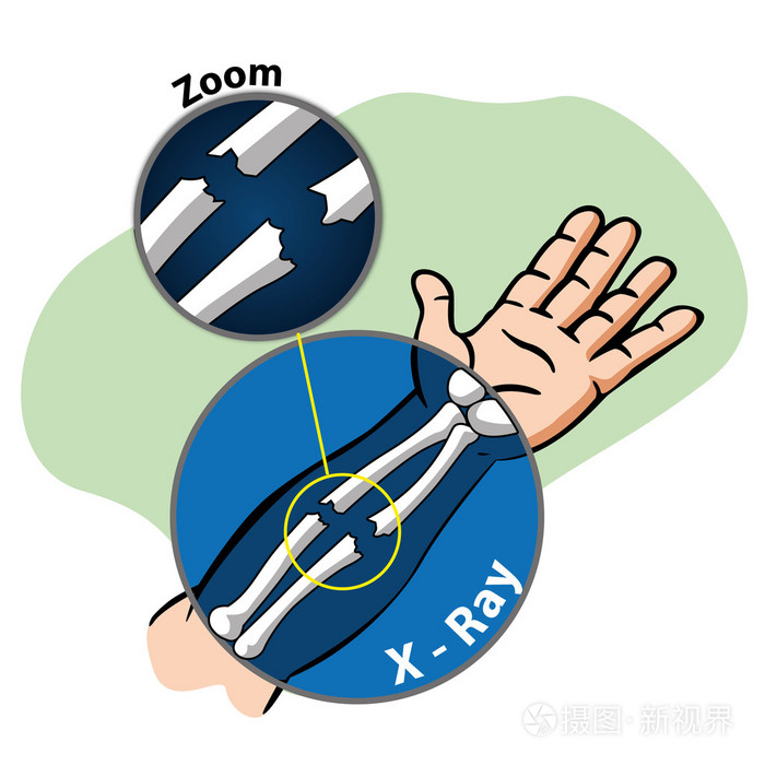 骨头断了图片卡通图片