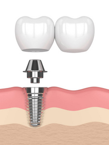 3d. 牙悬臂桥种植体植入术