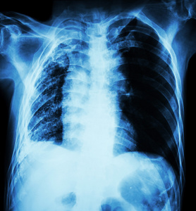 肺结核。胸部 x 线 右肺肺不张