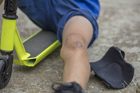 擦伤的膝盖的孩子.男孩腿受伤期间骑滑板车.