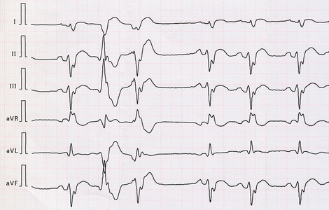 与 macrofocal 心肌梗死和双室性早搏的心电图