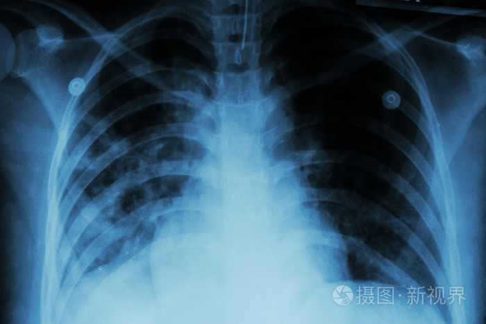 肺结核 (tb): 胸部 x 光显示肺泡浸润在这两个由于结核杆菌感染的肺
