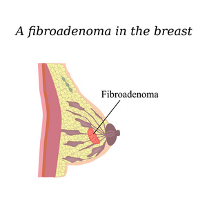 乳腺纤维腺瘤.. 在孤立的背景下。 结构