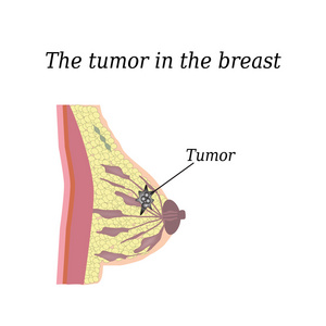 乳房里的肿瘤。 在孤立的背景上。 结构o