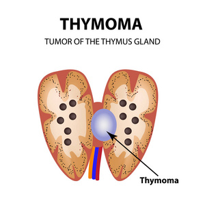 胸腺肿瘤。胸腺瘤。信息图表。对孤立背景矢量图