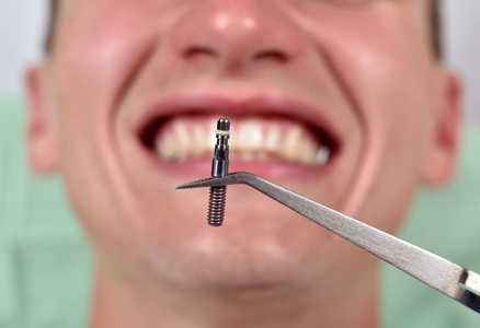 牙科植入物在镊子图片