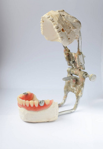 人工牙，用假银牙，牙齿上的金属冠牙体修复