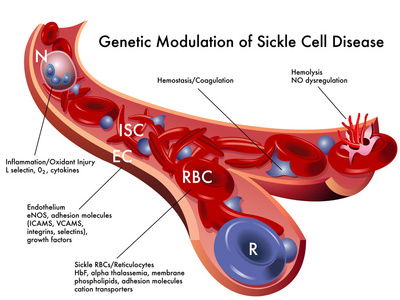 镰状细胞贫血病，镰刀形红细胞贫血病