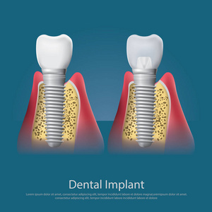 人类的牙齿与牙科植入物矢量图图片