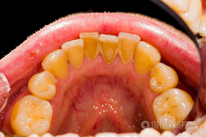 牙菌斑去除治疗