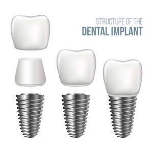 现实的健康牙和牙种植体