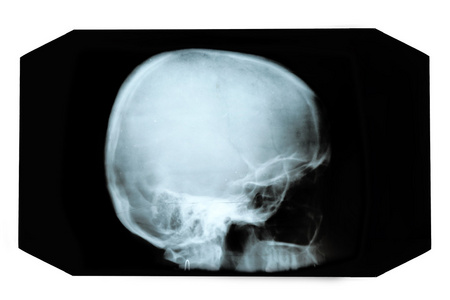 颅骨的 x 光片