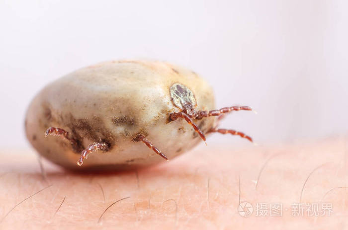 满腔热血坐在人体皮肤上的蜱虫
