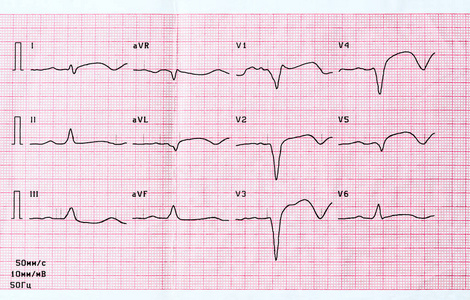 大焦广泛前壁心肌梗死急性期心电图照片