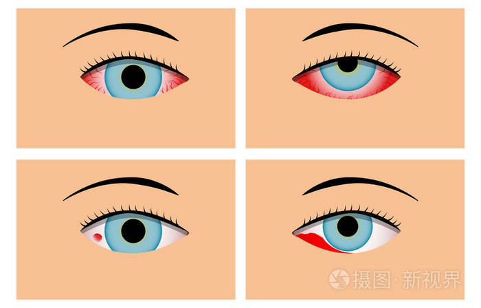 结膜炎和红血丝,矢量插画-正版商用图片0de2ru-摄图新视界