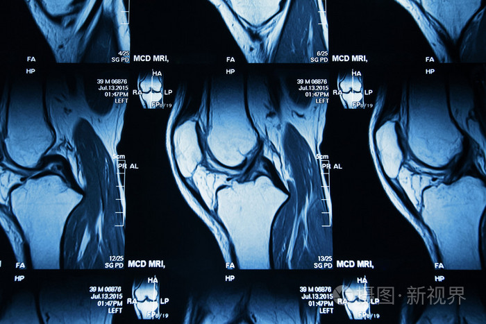 膝盖关节腿的 mri 影像学诊断