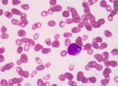 早幼粒细胞照片