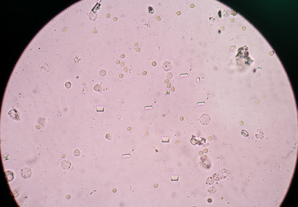 尿磷酸钙结晶图片