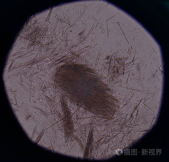 适度的尿酸晶体针形状