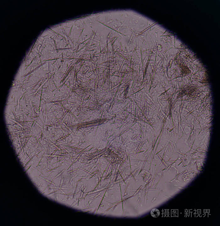 适度的尿酸晶体针形状