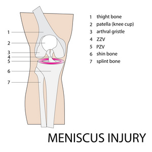 半月板损伤图片