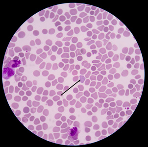 红细胞高渗图片